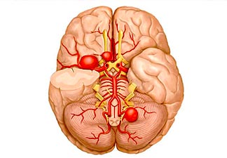 tratamento aneurismas cerebrais