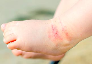 eczema-atópico